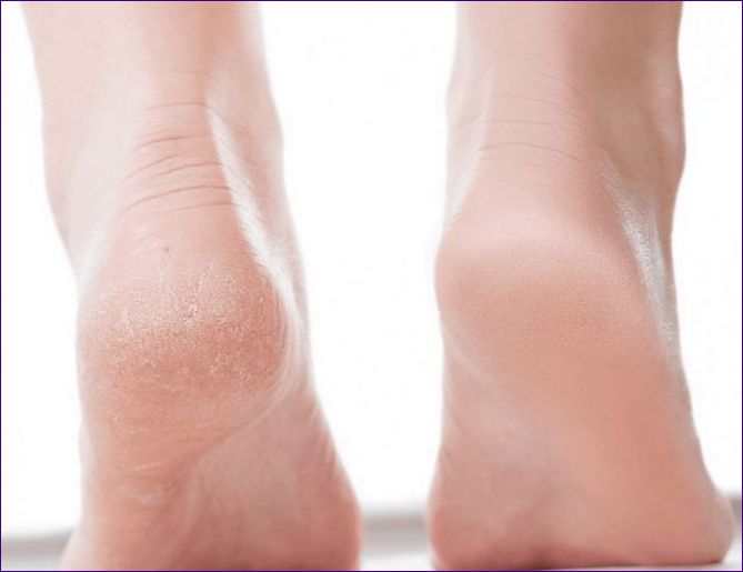 Suché paty: Příčiny suché kůže a co s tím dělat